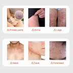 Body Acne Removal Cream Treatment Face Butt Back Acne Marks Smooth Repair Chicken Skin Cream Moisturizing Whitening Skin Care