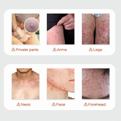 Body Acne Removal Cream Treatment Face Butt Back Acne Marks Smooth Repair Chicken Skin Cream Moisturizing Whitening Skin Care