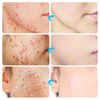 Body Acne Removal Cream Treatment Face Butt Back Acne Marks Smooth Repair Chicken Skin Cream Moisturizing Whitening Skin Care