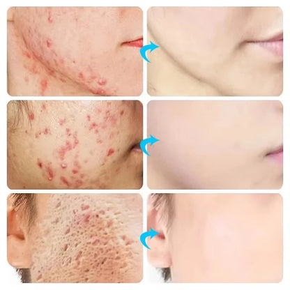 Body Acne Removal Cream Treatment Face Butt Back Acne Marks Smooth Repair Chicken Skin Cream Moisturizing Whitening Skin Care