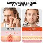 Body Acne Removal Cream Treatment Face Butt Back Acne Marks Smooth Repair Chicken Skin Cream Moisturizing Whitening Skin Care